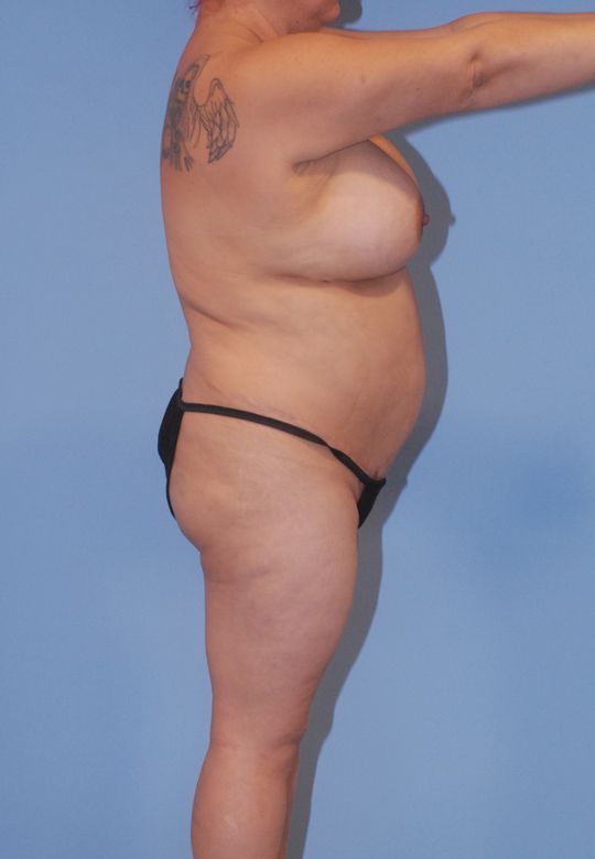 Liposuction Before & After