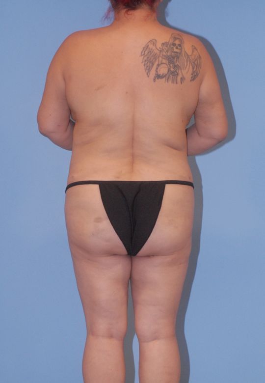Liposuction Before & After