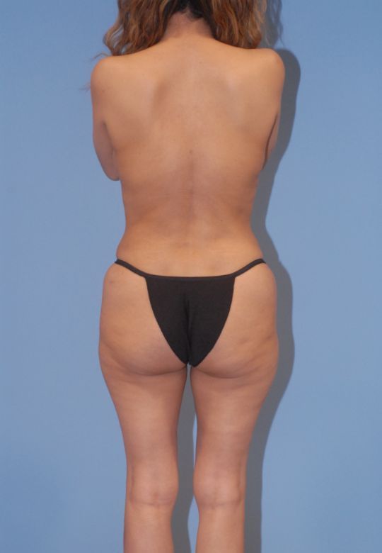 Liposuction Before & After