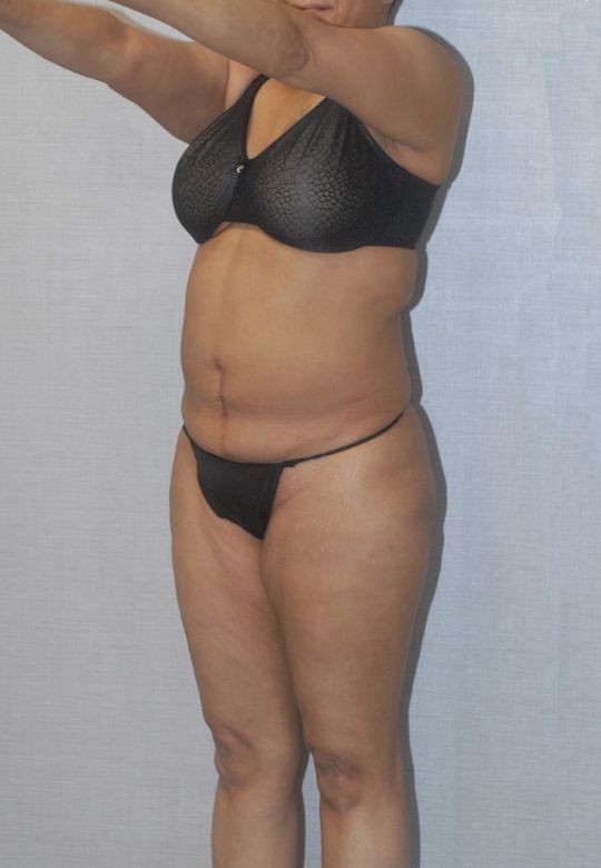 Liposuction Before & After