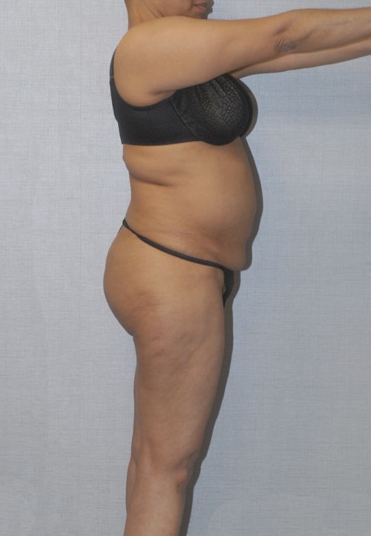 Liposuction Before & After