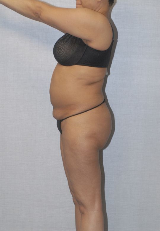 Liposuction Before & After