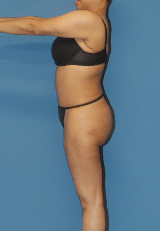 Liposuction Before & After