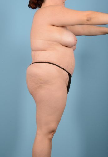 Liposuction Before & After