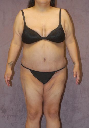 Liposuction Before & After