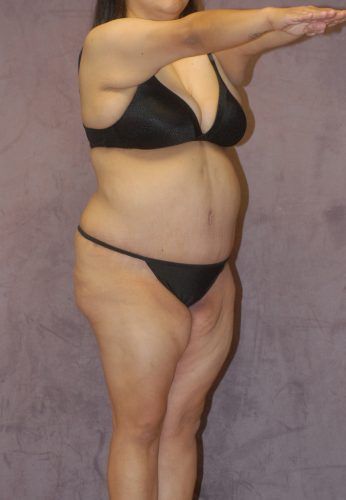 Liposuction Before & After