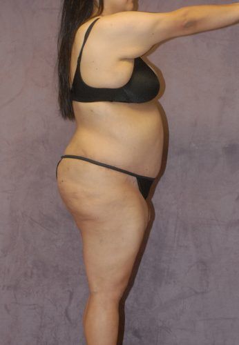 Liposuction Before & After