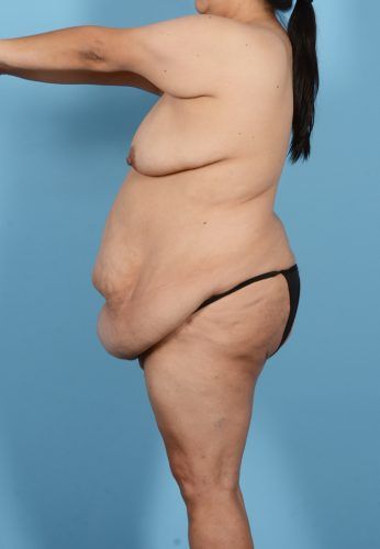 Liposuction Before & After