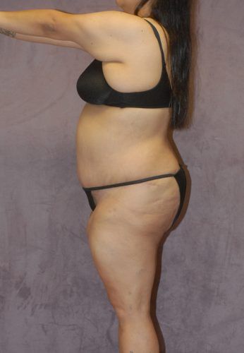 Liposuction Before & After