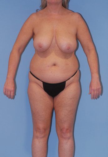 Liposuction Before & After