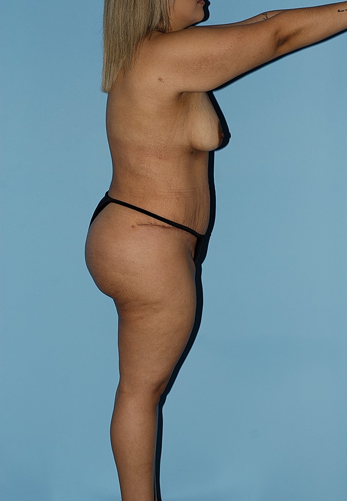 Liposuction Before & After