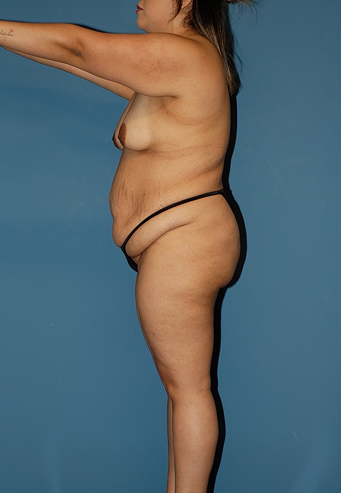 Liposuction Before & After
