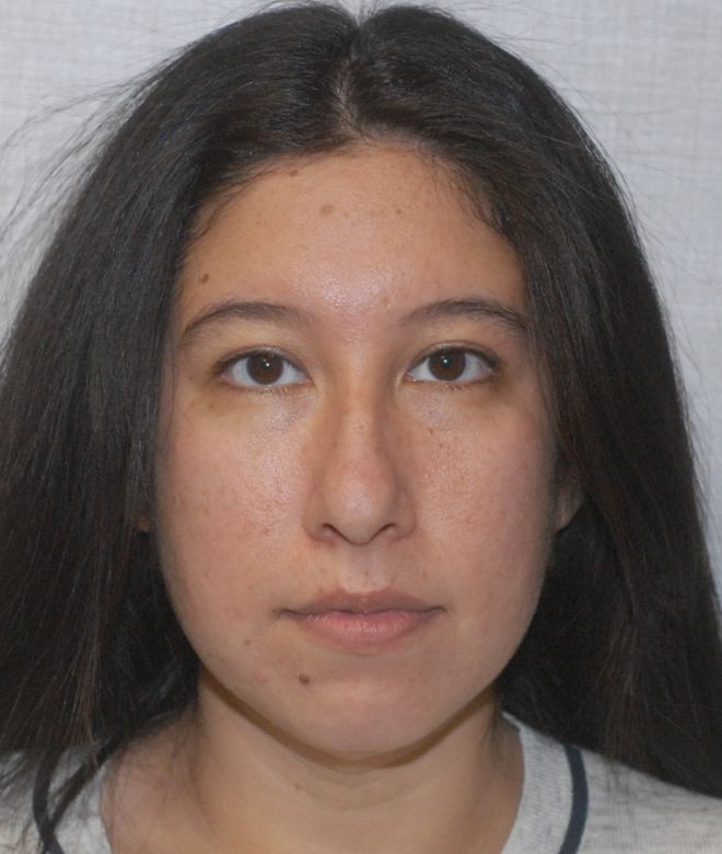 Chin Augmentation Before & After