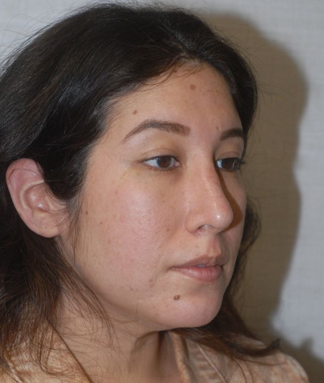 Chin Augmentation Before & After