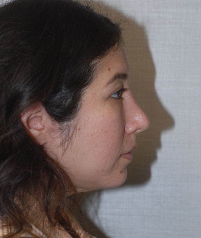 Chin Augmentation Before & After
