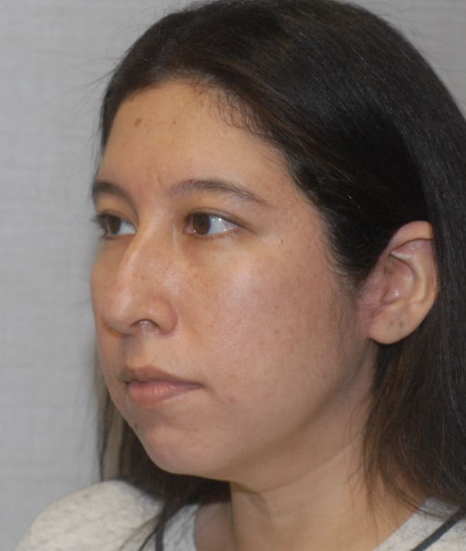 Chin Augmentation Before & After