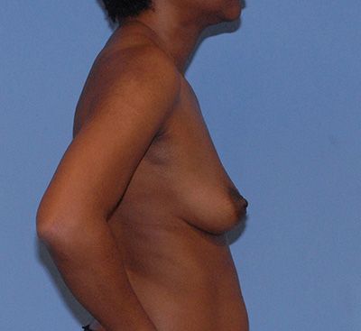 Motiva Breast Implants Before & After