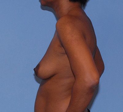 Motiva Breast Implants Before & After